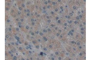 DAB staining on IHC-P; Samples: Human Liver cancer Tissue (MOK antibody  (AA 173-418))