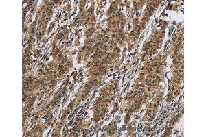 Immunohistochemistry of Human thyroid cancer using IL12RB2 Polyclonal Antibody at dilution of 1:40
