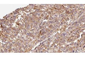 ABIN6279301 at 1/100 staining Human Melanoma tissue by IHC-P. (CMTM7 antibody  (Internal Region))