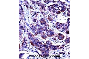 CASP6 Antibody (N-term) ((ABIN657756 and ABIN2846738))immunohistochemistry analysis in formalin fixed and paraffin embedded human bladder carcinoma followed by peroxidase conjugation of the secondary antibody and DAB staining. (Caspase 6 antibody  (N-Term))