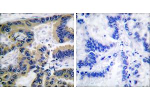 Cl-peptide - +Immunohistochemical analysis of paraffin-embedded human lung carcinoma tissue using Caspase 7 (cleaved-Asp198) antibody. (Caspase 7 antibody  (Cleaved-Asp198))