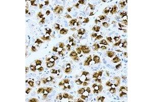 Immunohistochemical analysis of ASMTL staining in human gastric cancer formalin fixed paraffin embedded tissue section. (ASMTL antibody)