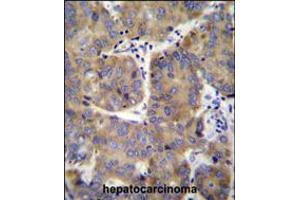 EIF3H Antibody immunohistochemistry analysis in formalin fixed and paraffin embedded human hepatocarcinoma followed by peroxidase conjugation of the secondary antibody and DAB staining. (EIF3H antibody  (N-Term))