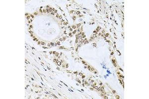 Immunohistochemistry of paraffin-embedded human gastric cancer using MCL1 antibody (ABIN5970080) at dilution of 1/100 (40x lens). (MCL-1 antibody  (C-Term))