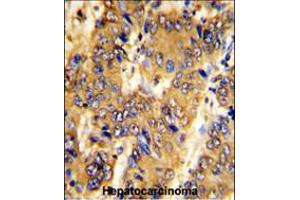 Formalin-fixed and paraffin-embedded human hepatocarcinoma with MSRB2 Antibody , which was peroxidase-conjugated to the secondary antibody, followed by DAB staining. (MSRB2 antibody  (AA 44-73))