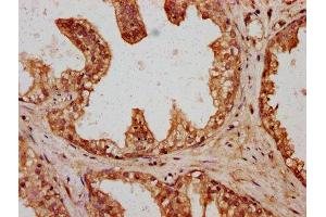 IHC image of ABIN7166723 diluted at 1:400 and staining in paraffin-embedded human prostate cancer performed on a Leica BondTM system. (HYI antibody  (AA 1-174))