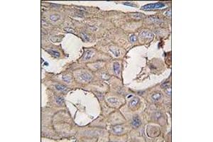 Formalin-fixed and paraffin-embedded human lung carcinoma tissue reacted with ANXA2 antibody (N-term), which was peroxidase-conjugated to the secondary antibody, followed by DAB staining. (Annexin A2 antibody  (N-Term))