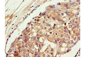 Immunohistochemistry of paraffin-embedded human breast cancer using ABIN7153080 at dilution of 1:100
