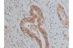 ABIN6267373 at 1/50 staining human colon carcinoma tissue sections by IHC-P.