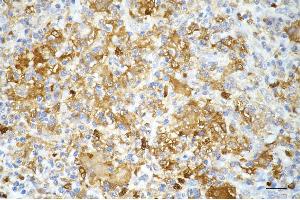 Immunohistochemistry was performed on paraffin-embedded human hepatocarcinoma using phosphogluconate dehydrogenase antibody (ABIN7799807), 1:200). (Recombinant PGD antibody)