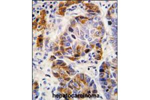 Formalin-fixed and paraffin-embedded human hepatocarcinoma tissue reacted with ALDH4A1 antibody , which was peroxidase-conjugated to the secondary antibody, followed by DAB staining. (ALDH4A1 antibody  (AA 288-314))