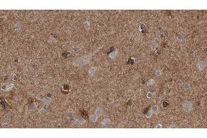 ABIN6277707 at 1/100 staining Human brain cancer tissue by IHC-P. (SH3G2 antibody  (Internal Region))