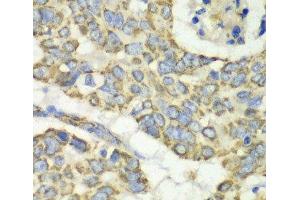 Immunohistochemistry of paraffin-embedded Human esophageal cancer using TUFM Polyclonal Antibody at dilution of 1:100 (40x lens). (TUFM antibody)