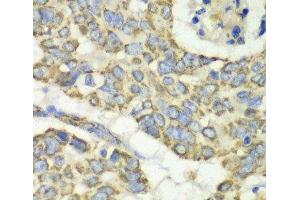 Immunohistochemistry of paraffin-embedded Human esophageal cancer using TUFM Polyclonal Antibody at dilution of 1:100 (40x lens).