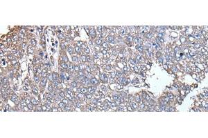 Immunohistochemistry of paraffin-embedded Human liver cancer tissue using SCP2 Polyclonal Antibody at dilution of 1:35(x200) (SCP2 antibody)