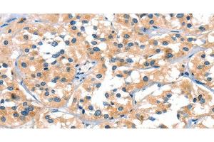 Immunohistochemistry of paraffin-embedded Human thyroid cancer tissue using SLC6A4 Polyclonal Antibody at dilution of 1:30 (SLC6A4 antibody)
