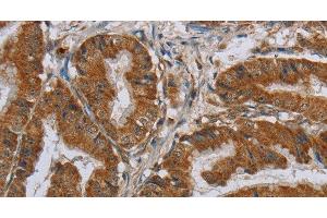 Immunohistochemistry of paraffin-embedded Human esophagus cancer using CSH1 Polyclonal Antibody at dilution of 1:40 (CSH1 antibody)