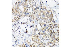 Immunohistochemistry of paraffin-embedded human breast cancer using R Rabbit pAb (ABIN3017320, ABIN3017321, ABIN3017322 and ABIN6220039) at dilution of 1:200 (40x lens). (RAMP2 antibody  (AA 1-145))