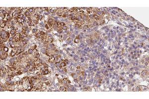 ABIN6279677 at 1/100 staining Human liver cancer tissue by IHC-P. (KCNG4 antibody  (Internal Region))