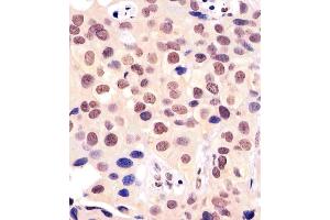 (ABIN6242199 and ABIN6577161) staining BANP in human breast carcinoma tissue sections by Immunohistochemistry (IHC-P - paraformaldehyde-fixed, paraffin-embedded sections). (BANP antibody  (AA 30-390))