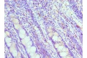 Immunohistochemistry of paraffin-embedded human colon cancer using ABIN7160088 at dilution of 1:100 (MAD2L1 antibody  (AA 1-205))