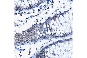 Immunohistochemistry of paraffin-embedded human colon using RPP25 Rabbit pAb (ABIN6133248, ABIN6147176, ABIN6147177 and ABIN6225317) at dilution of 1:100 (40x lens). (RPP25 antibody  (AA 1-199))