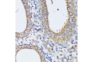 Immunohistochemistry of paraffin-embedded human uterine cancer using ERK1 / ERK2 antibody (ABIN7268619) at dilution of 1:200 (40x lens). (ERK1 antibody  (AA 200-300))