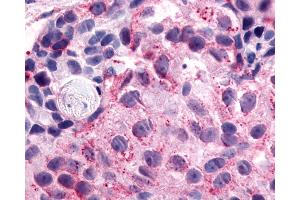 Anti-NPFFR1 / GPR147 antibody IHC of human Breast, Carcinoma. (NPFFR1 antibody  (C-Term))