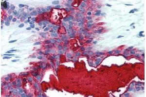 Human Breast (formalin-fixed, paraffin-embedded) stained with MUC1 antibody ABIN396912 at 5 ug/ml followed by biotinylated anti-mouse IgG secondary antibody ABIN481714, alkaline phosphatase-streptavidin and chromogen. (MUC1 antibody)