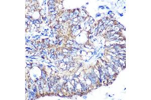 Immunohistochemistry of paraffin-embedded human colon carcinoma using IDH2 Rabbit mAb (ABIN7268028) at dilution of 1:100 (40x lens). (IDH2 antibody)