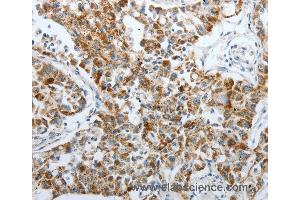 Immunohistochemistry of Human lung cancer using PDK2 Polyclonal Antibody at dilution of 1:40 (PDK2 antibody)