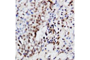 Anti-ERK1 antibody, IHC(P) IHC(P): Human Mammary Cancer Tissue (ERK1 antibody  (Middle Region))