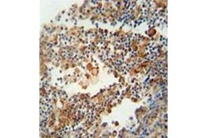 Immunohistochemistry analysis in formalin fixed and paraffin embedded human lung carcinoma reacted with OR9Q1 Antibody (C-term) Cat. (OR9Q1 antibody  (C-Term))