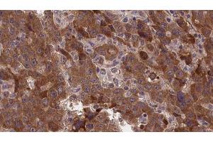 ABIN6277375 at 1/100 staining Human liver cancer tissue by IHC-P. (GLRA1 antibody  (Internal Region))