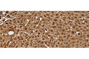 Immunohistochemistry of paraffin-embedded Human lung cancer tissue using LAMTOR5 Polyclonal Antibody at dilution of 1:35(x200)