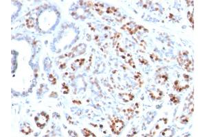Formalin-fixed, paraffin-embedded human Breast Carcinoma stained with GATA-3 Mouse Monoclonal Antibody (GATA3/2444). (GATA3 antibody  (AA 357-436))