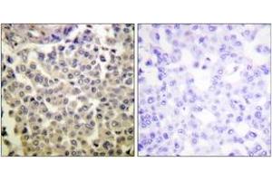 Immunohistochemistry analysis of paraffin-embedded human breast carcinoma, using PAK1/2/3 (Phospho-Thr423/402/421) Antibody. (PAK1/2/3 antibody  (pThr423))