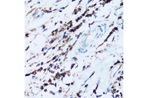 Immunohistochemistry of paraffin-embedded human breast cancer using SPN antibody (ABIN5973813) at dilution of 1/100 (40x lens). (CD43 antibody)