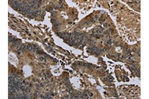 The image on the left is immunohistochemistry of paraffin-embedded Human colon cancer tissue using ABIN7129664(GSTO1 Antibody) at dilution 1/60, on the right is treated with fusion protein. (GSTO1 antibody)