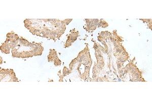 Immunohistochemistry of paraffin-embedded Human thyroid cancer tissue using HDHD2 Polyclonal Antibody at dilution of 1:40(x200) (HDHD2 antibody)