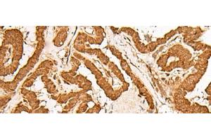 Immunohistochemistry of paraffin-embedded Human thyroid cancer tissue using GMEB2 Polyclonal Antibody at dilution of 1:35(x200) (GMEB2 antibody)