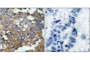 Immunohistochemistry analysis of paraffin-embedded human breast carcinoma tissue, using Src (Ab-529) Antibody. (Src antibody  (AA 487-536))