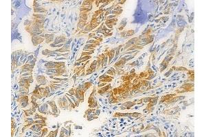 STAT1 Antibody at 1/100 staining human lung adenocarcinoma by IHC-P.