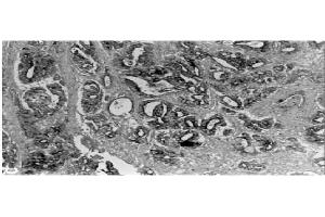 Immunohistochemical staining  of human gastric carcinoma tissue using MMP-3 antibody . (MMP3 antibody  (C-Term))