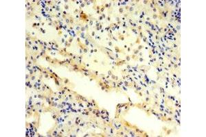 Immunohistochemistry of paraffin-embedded human lung cancer using ABIN7142230 at dilution of 1:100 (PSMC3 antibody  (Regulatory Subunit 6A))
