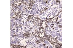 IHC testing of FFPE human lung cancer tissue with MVP antibody at 1ug/ml. (MVP antibody)