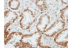 IHC-P Image Immunohistochemical analysis of paraffin-embedded human gastric cancer, using RGS14, antibody at 1:100 dilution. (RGS14 antibody  (C-Term))