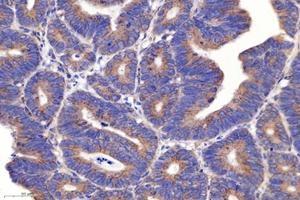 Immunohistochemistry analysis of paraffin-embedded human colon cancer using PSMD8 (ABIN7075226) at dilution of 1: 2600 (PSMD8 antibody)