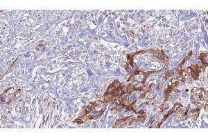 ABIN6274443 at 1/100 staining Human urothelial cancer tissue by IHC-P.