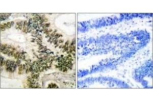 Immunohistochemistry analysis of paraffin-embedded human colon carcinoma tissue, using Cyclin E1 (Ab-395) Antibody. (Cyclin E1 antibody  (AA 361-410))